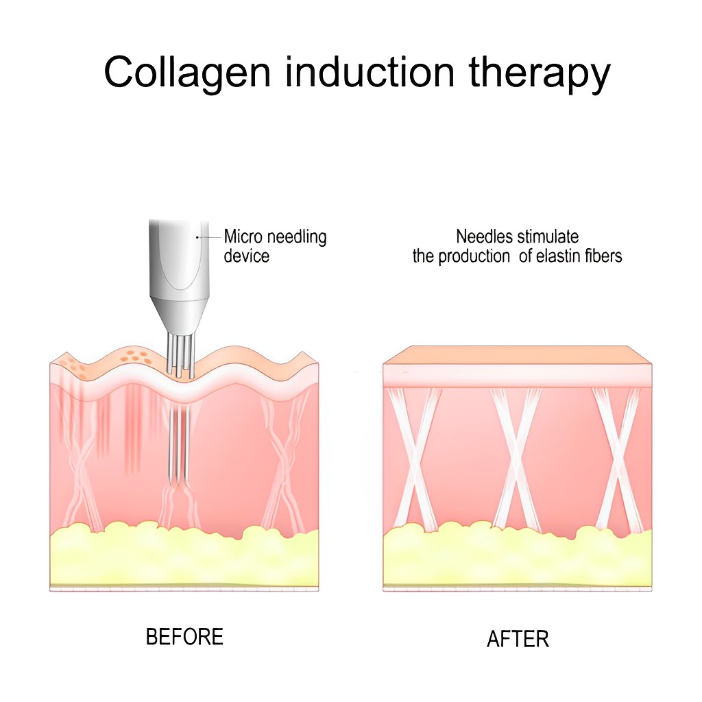  Collagen induction therapy